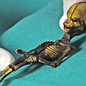 Médico descobre um misterioso corpo alienígena de 18 cm no Chile