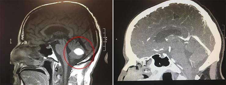 tumor cerebral milagre médico - Os médicos não podem explicar como o tumor cerebral de um padre desaparece pouco antes de ser operado, doutor milagre