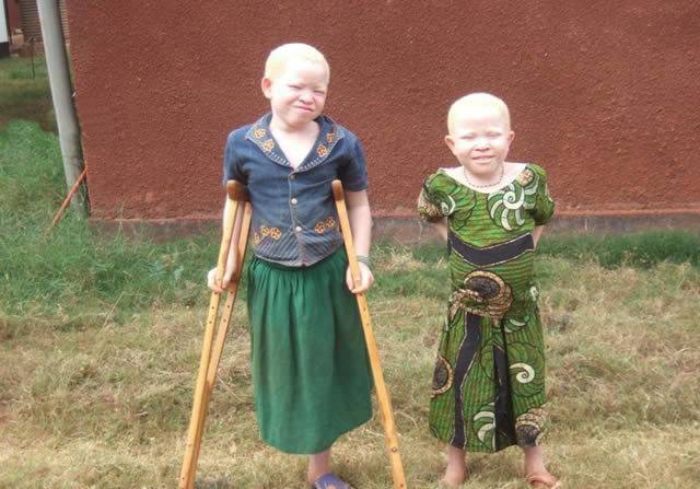 A triste realidade dos albinos