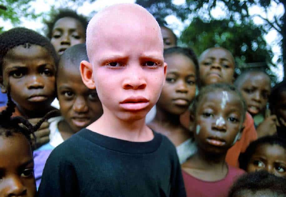 A vida dos negros albinos na África