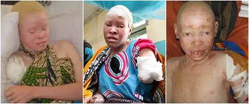 Crianças albinas vítimas de bruxaria na Tanzânia