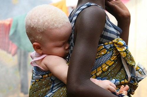 Criança albina na África. Crédito - AFP