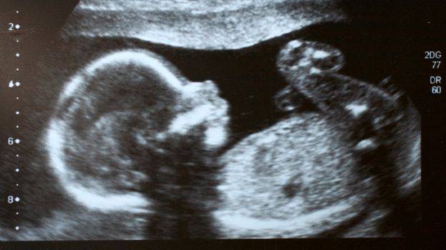 Um ultrassom mostrou que Itzamara estava desenvolvendo um feto no abdômen