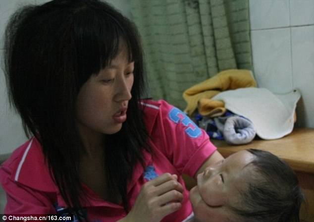 Condição rara - Duas enormes lacunas aparecem de ambos os lados da boca de Huikang levando em direção às orelhas. Sua mãe o segurou durante o tratamento em 2010