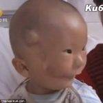 Imagens de TV da época mostravam que Huikang já estava com uma aparência melhor após a primeira operação.