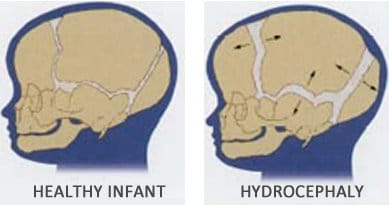 Expansão de suturas em criança hidrocefálica.